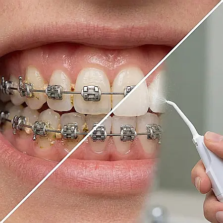Irigator Bucal Manual pentru Igienă Orală – 40 ml, Jet de Apă Puternic, Curățare Interdentară, Alb, Fără Baterii sau Încărcare, Ideal pentru Aparat Dentar, Coroane și Punți [3]